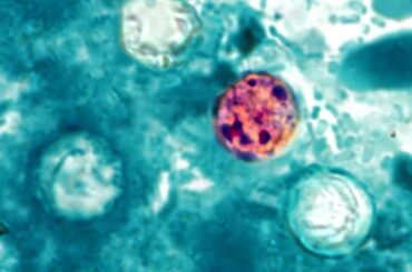Cyclospora outbreak: Nebraska officials report rapid increase