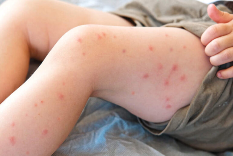 Kyoto Sushi & Steak put on alert after measles exposure