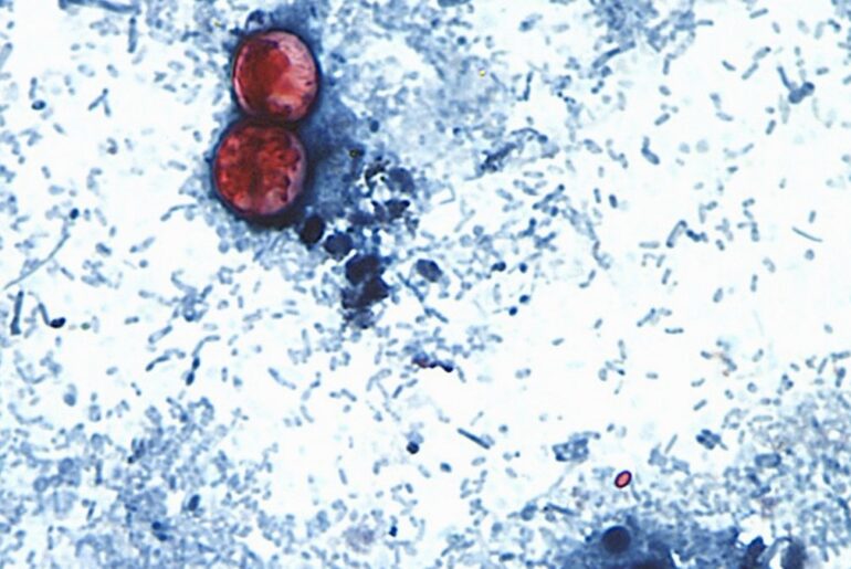 Cyclospora found at Mexican farm linked to lettuce outbreak: FDA – NBC Chicago